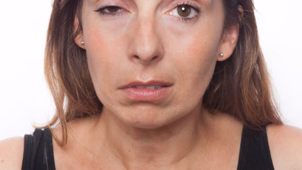 N. facialis parese (aangezichtsverlamming)