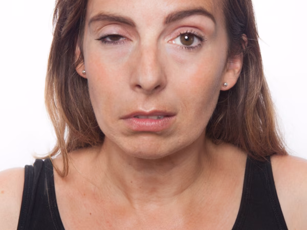 N. facialis parese (aangezichtsverlamming)