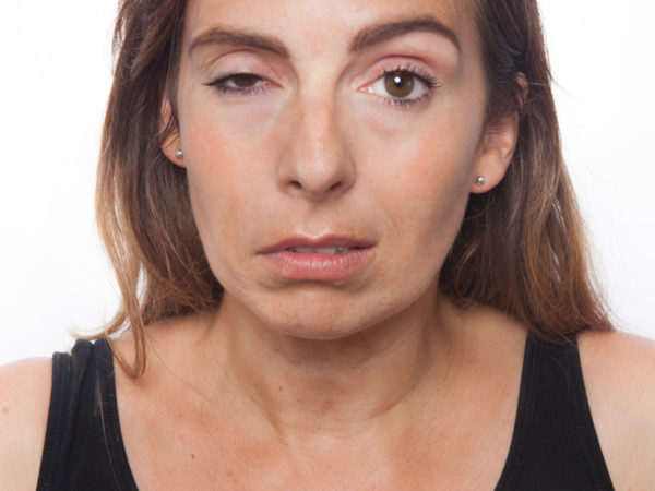 N. facialis parese (aangezichtsverlamming)